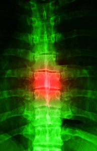 红色为疼痛与人体脊柱 x 射线