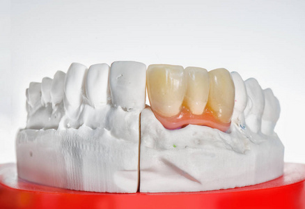 牙科人工 labora 的牙齿假体技术镜头