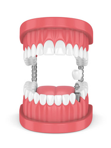 3d. 下颌牙和牙前磨牙植入术