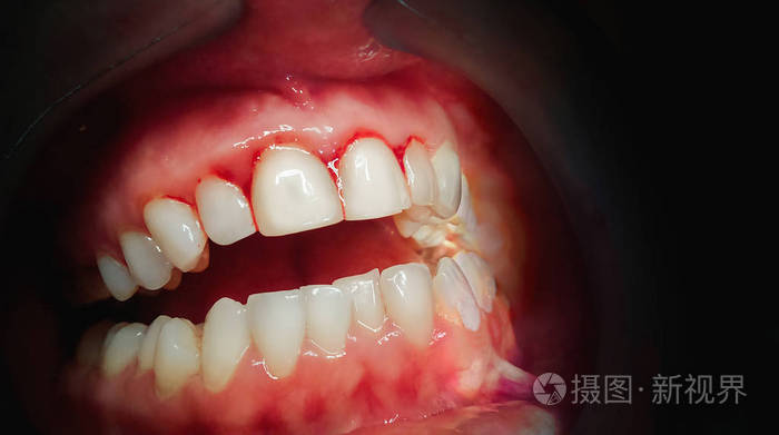 在黑暗背景下牙龈出血的口腔