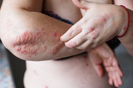 人们用手手臂发痒保健和医学的概念来搔痒。手上有湿疹或牛皮癣