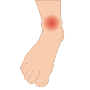 肿胀的脚和脚踝从感染或损伤图片