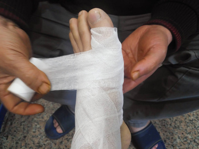 在农村诊所用绷带包扎受伤的脚