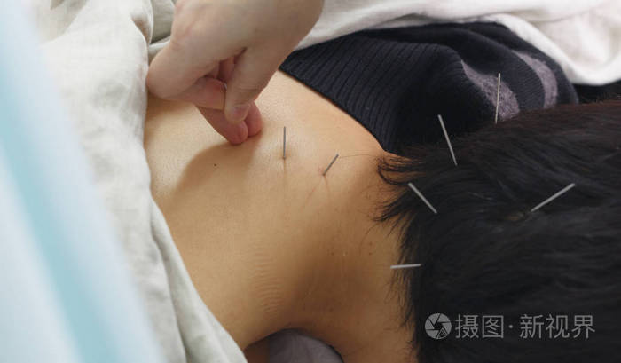针灸法照片-正版商用图片04ers1-摄图新视界