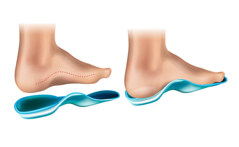 矫形鞋垫。矫正弓支架