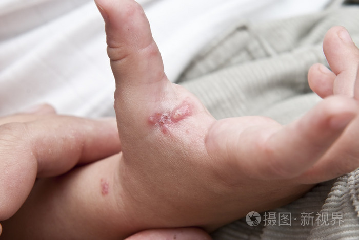 在孩子手中的带状疱疹