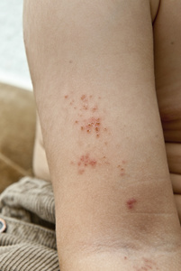 疱疹晚期症状图片