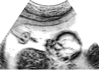 妊娠期母亲子宫超声的医学图像图片