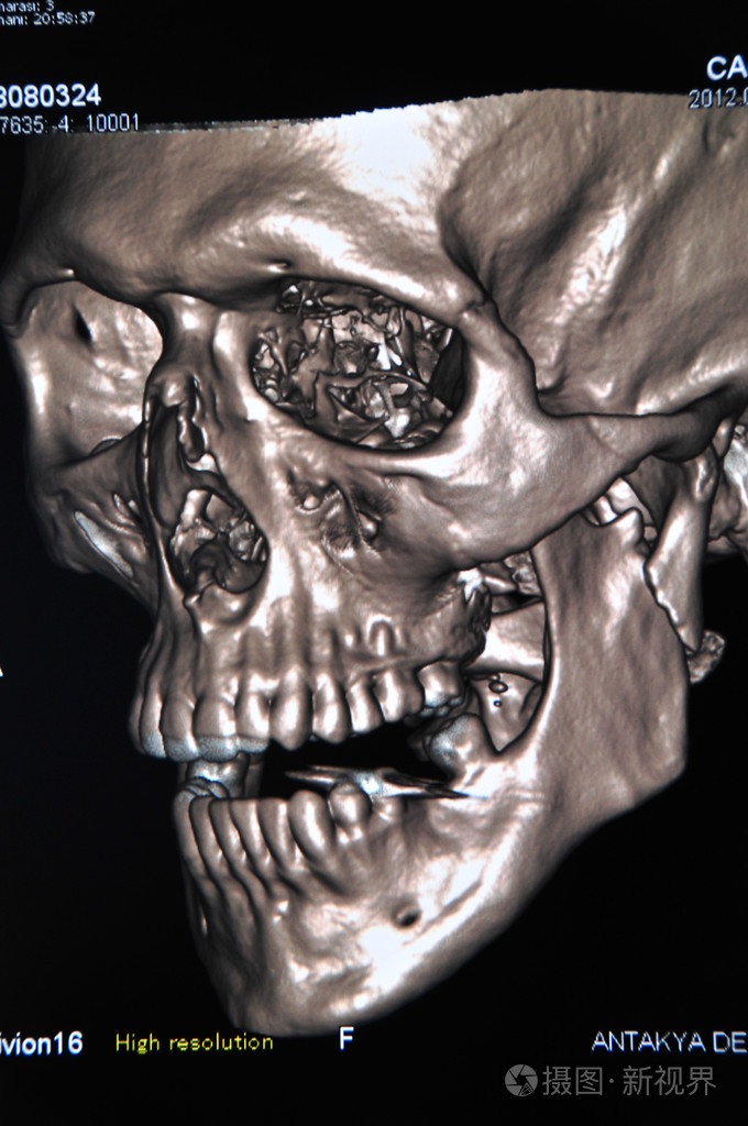 头颅ct照片-正版商用图片04kywu-摄图新视界