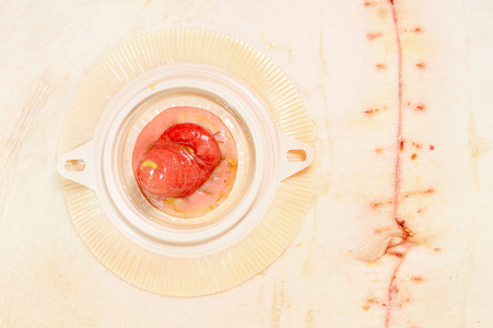 结肠造口术照片