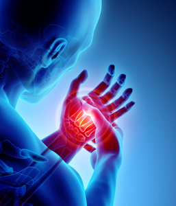 手掌疼痛-骨骼 x 光, 医学概念照片