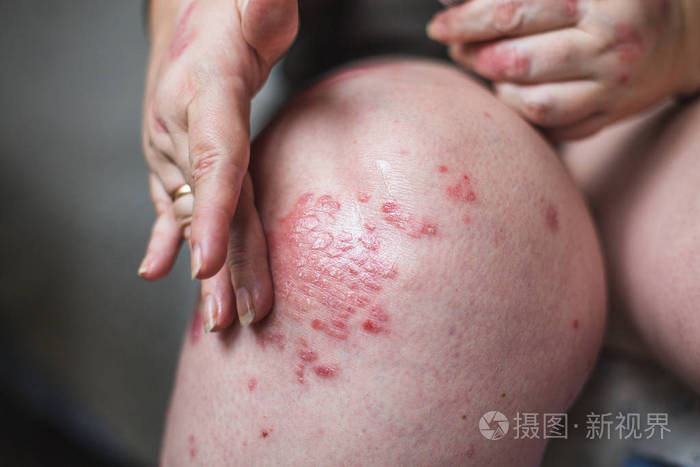 在治疗牛皮癣湿疹和其他干燥皮肤的情况下应用润肤剂干燥片状皮肤水平