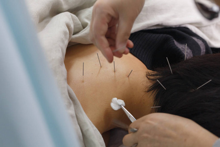 空调场景针灸法照片