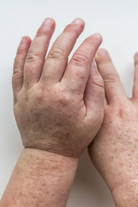 两个孩子手里有传染性的红色小皮疹.白色背景照片