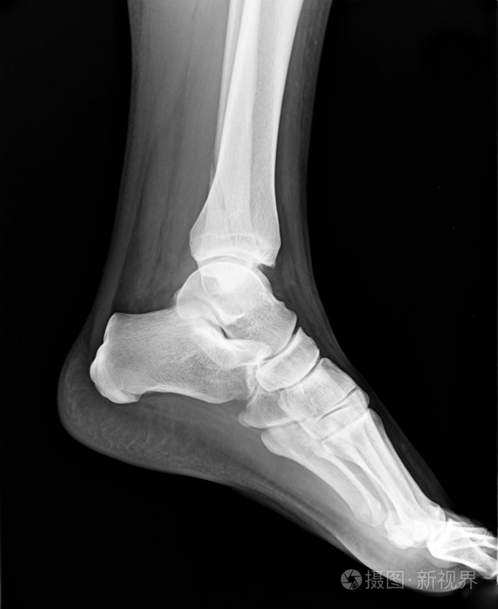 左脚脚趾磁共振成像x线