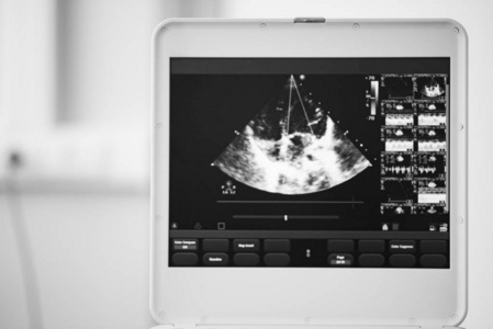 在超声扫描仪的屏幕上, 心脏在四室位置的图像和蓝色多普勒方法标记的是二尖瓣返流。黑白照片