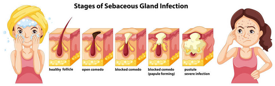 皮脂腺感染的一个阶段图示