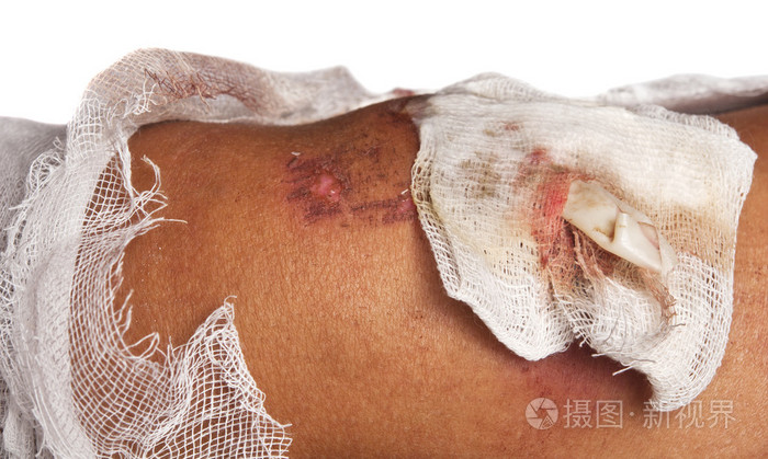 绷带的伤口
