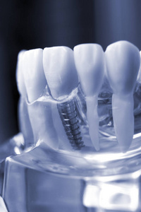 牙科牙医牙科教学模型显示钛金属牙植入螺钉