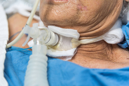 亚洲老年妇女 80s. 气管切开术使用呼吸机呼吸帮助在重症监护病房 Icu 的病人床上. 医院的房间