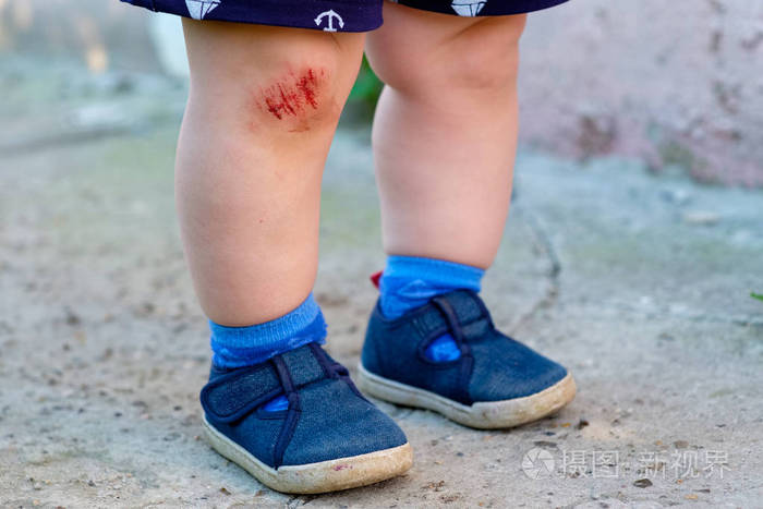 在一个小欧洲男孩的沥青下降的结果, 他的膝盖上的血液磨损照片-正版