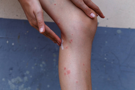 手上有蚊子咬伤皮肤上的柔软发痒的红色突起