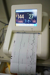 Cardiotocograph 记录胎儿心率和子宫收缩率