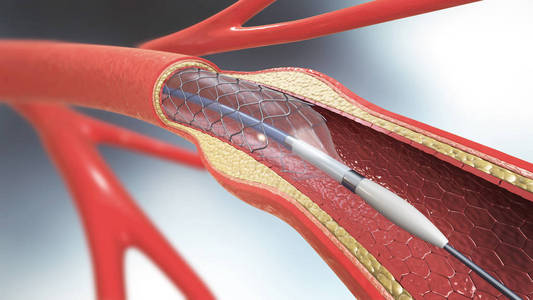 3d. 支架植入术在血管内支持血液循环的例证