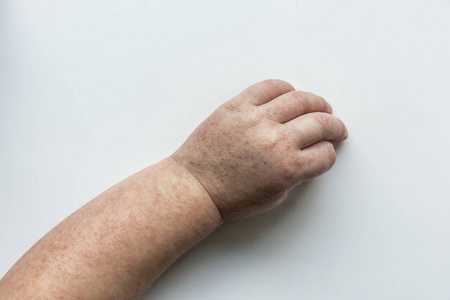 儿童猩红热图片