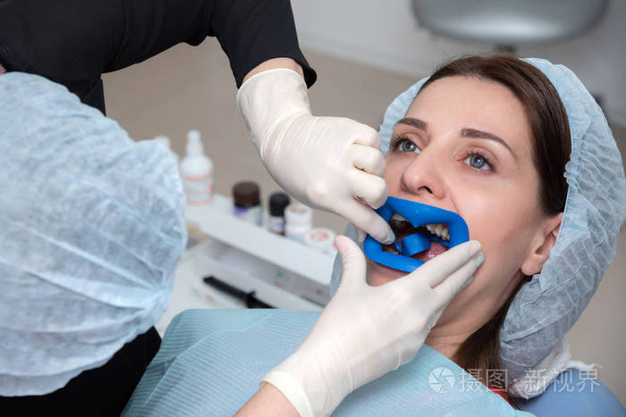 在紫外线灯的帮助下, 口腔有准备漂白.特写