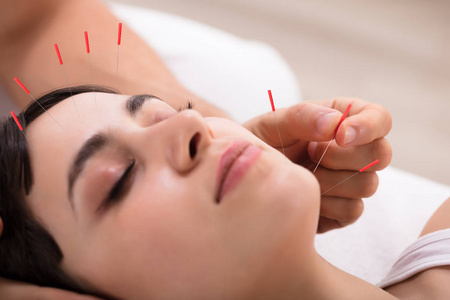 美丽的年轻女子获得针灸治疗美容水疗照片