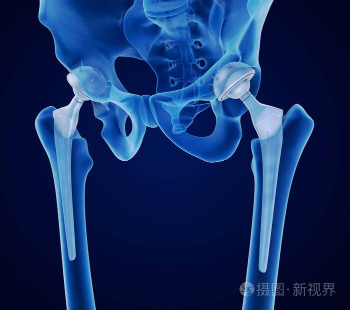 髋关节置换植入物安装在骨盆骨.x 射线视图.医学上精确的3d 例证