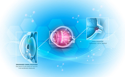 青光眼眼疾图片