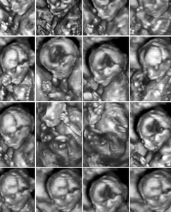 拼贴的 16 医学图像的三维超声异常处理扫描在女性胎儿 4 个月到怀孕