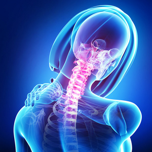 颈部疼痛女性的 x 射线