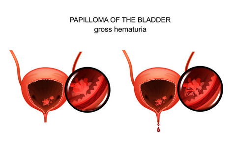 膀胱内一例乳突瘤的矢量图示