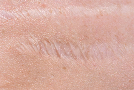 疤痕缝合图片-疤痕缝合素材-疤痕缝合插画-摄图新视界