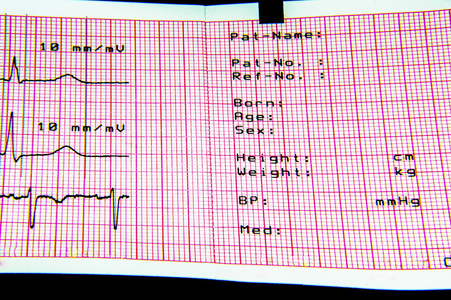 心电图诊断表图片