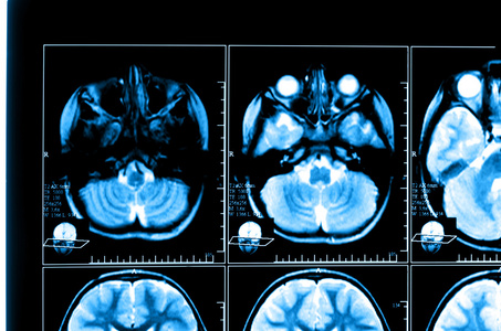 计算机扫描大脑的 x 射线图像计算机断层扫描照片