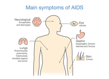 主要症状的急性 Hiv 感染