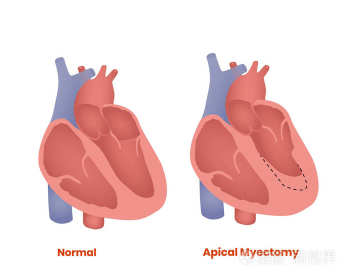 顶端myectomy.肥厚型心肌病的治疗