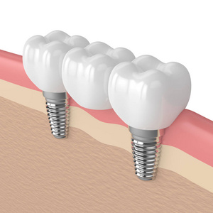 3d. 植入物支撑牙桥