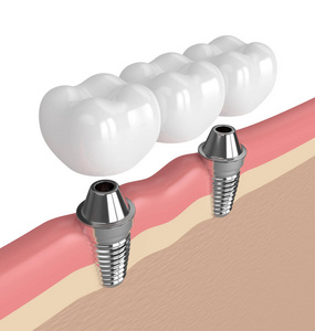 3d. 植入物支撑牙桥