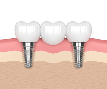 3d. 植入物支撑牙桥
