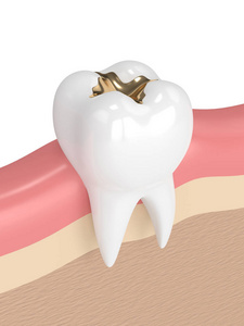 3d 牙齿金填充牙的渲染
