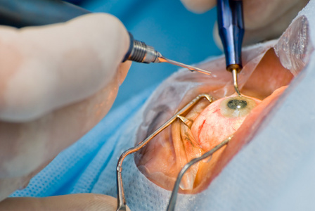 白内障晶状体白内障手术照片