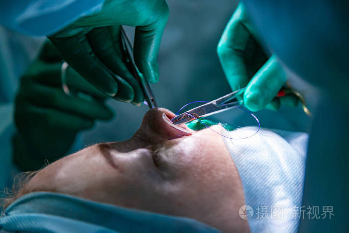 外科医生和他的助手执行整容手术在医院手术室的鼻子上.鼻整形, 隆胸.