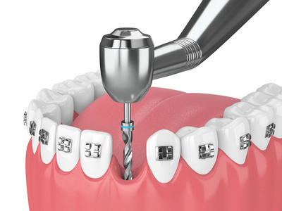 3d. 用正畸牙套和牙科钻头进行牙齿的渲染。正畸牙箍概念