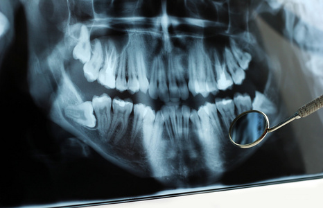 牙科 x 线反映在口腔镜