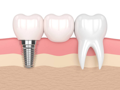 3d. 牙悬臂桥种植体植入术